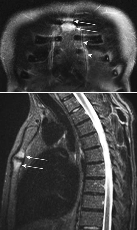 Anterior chest wall inflammation by whole.